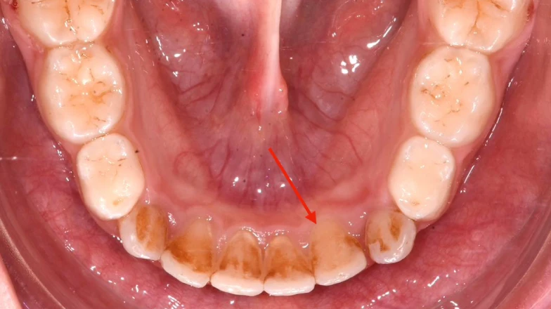 Cas cliniques au cabinet d'orthodontie du Dr Sebbag à Cagnes-sur-Mer, près de Nice