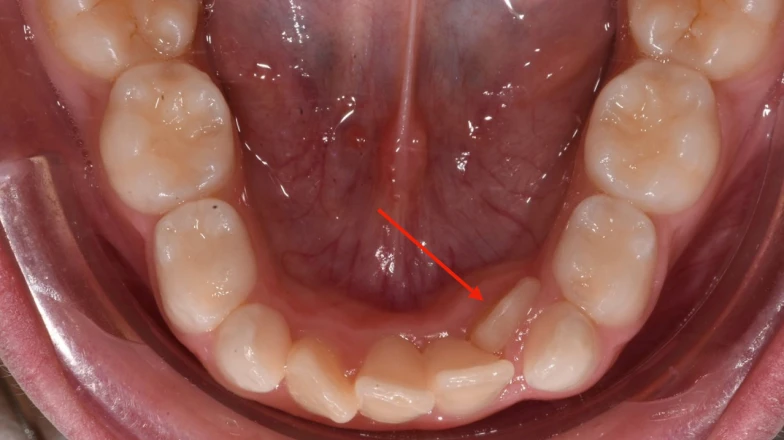 Cas cliniques au cabinet d'orthodontie du Dr Sebbag à Cagnes-sur-Mer, près de Nice