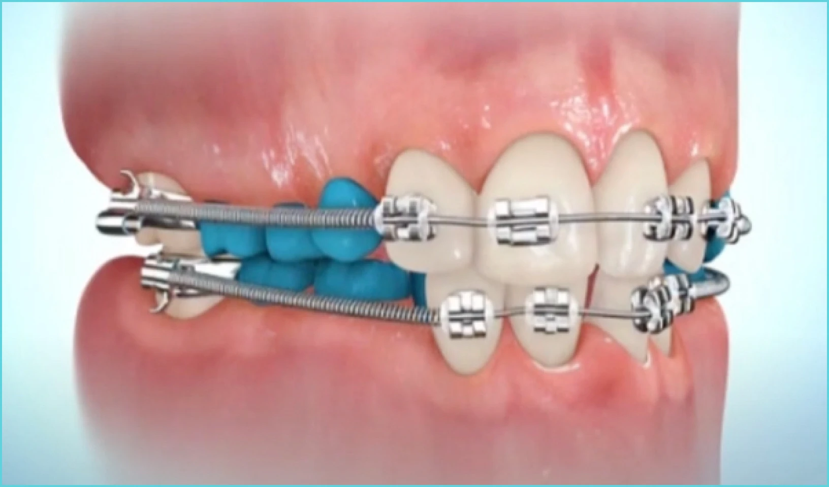 Appareillage fixe sectoriel au cabinet d'orthodontie du Dr Sebbag à Cagnes-sur-Mer