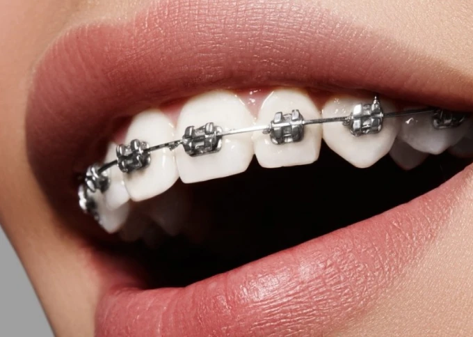 Bagues : traitements orthodontiques pour les adolescents et les adultes au cabinet du Dr Michael Sebbag